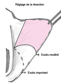 résection des petites lèvres dans la nymphoplastie